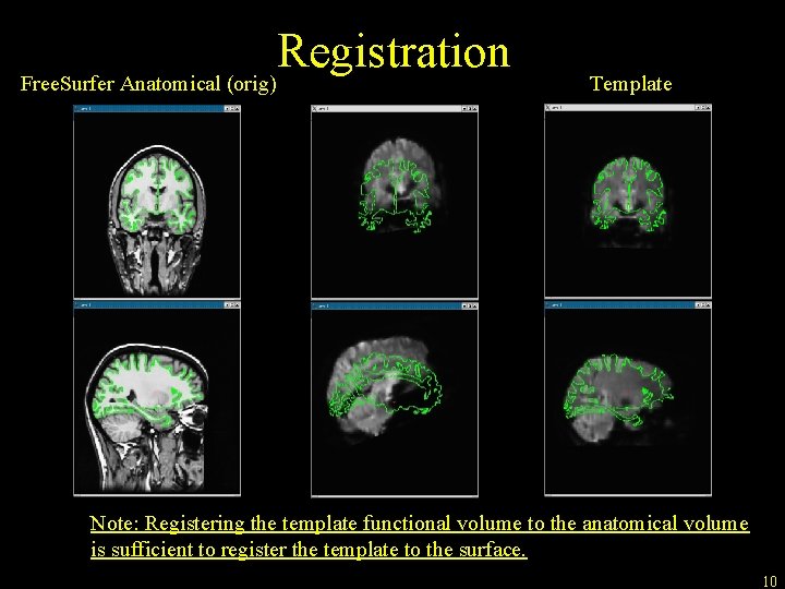 Registration Free. Surfer Anatomical (orig) Template Note: Registering the template functional volume to the