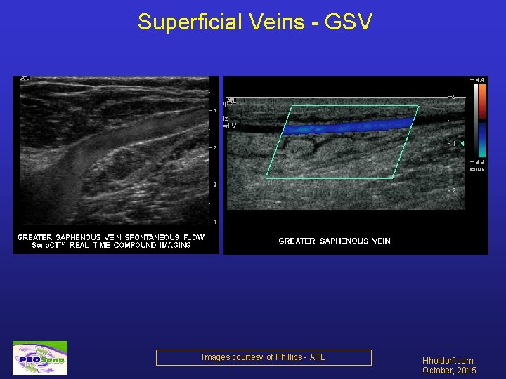 Superficial Veins - GSV Images courtesy of Phillips - ATL Hholdorf. com October, 2015