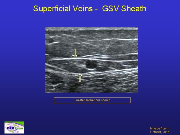 Superficial Veins - GSV Sheath Greater saphenous sheath Hholdorf. com October, 2015 