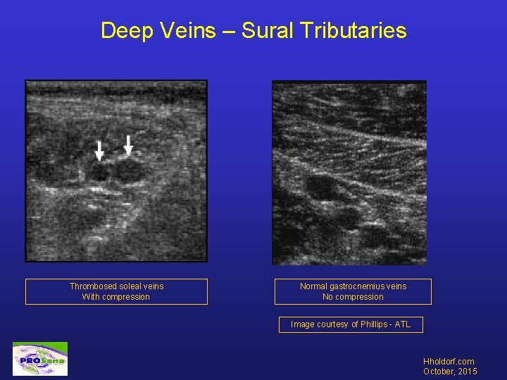 Deep Veins – Sural Tributaries Thrombosed soleal veins With compression Normal gastrocnemius veins No