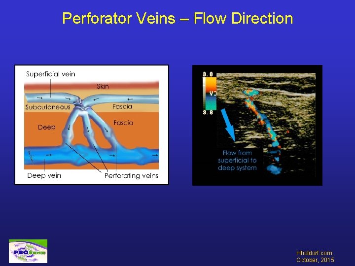 Perforator Veins – Flow Direction Hholdorf. com October, 2015 