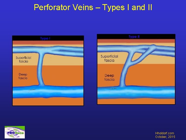 Perforator Veins – Types I and II Hholdorf. com October, 2015 
