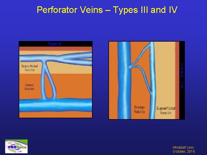 Perforator Veins – Types III and IV Hholdorf. com October, 2015 