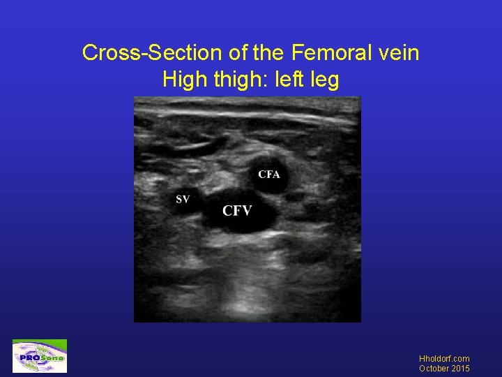 Cross-Section of the Femoral vein High thigh: left leg Hholdorf. com October 2015 