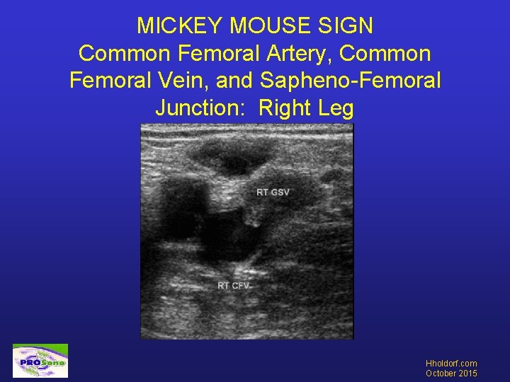 MICKEY MOUSE SIGN Common Femoral Artery, Common Femoral Vein, and Sapheno-Femoral Junction: Right Leg