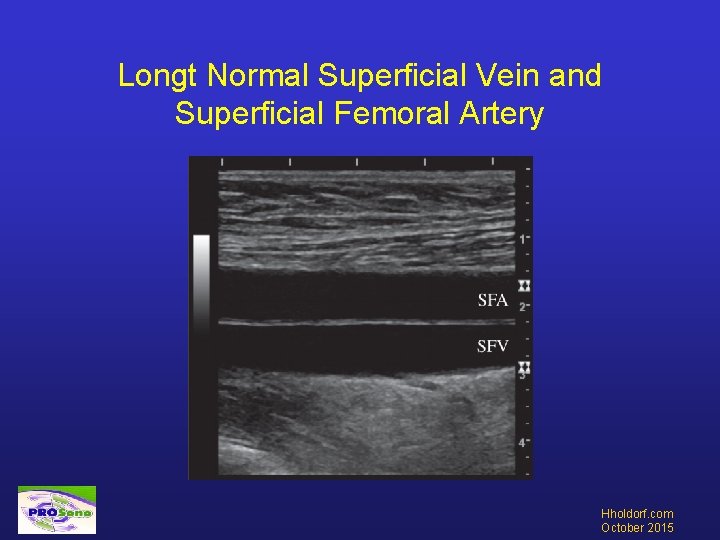 Longt Normal Superficial Vein and Superficial Femoral Artery Hholdorf. com October 2015 