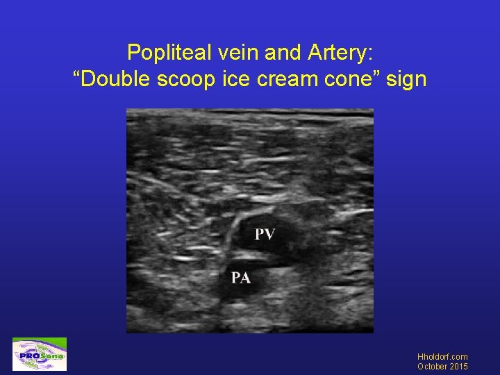 Popliteal vein and Artery: “Double scoop ice cream cone” sign Hholdorf. com October 2015