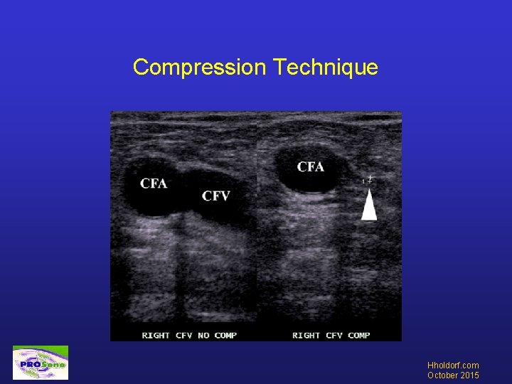 Compression Technique Hholdorf. com October 2015 