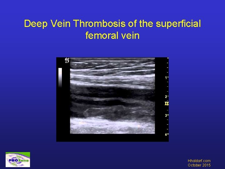 Deep Vein Thrombosis of the superficial femoral vein Hholdorf. com October 2015 