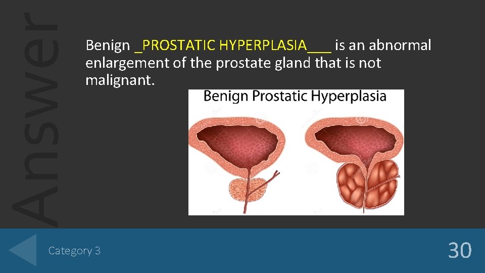Answer Benign _PROSTATIC HYPERPLASIA___ is an abnormal enlargement of the prostate gland that is Answer Benign _PROSTATIC HYPERPLASIA___ is an abnormal enlargement of the prostate gland that is