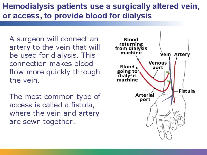 Hemodialysis patients use a surgically altered vein, or access, to provide blood for dialysis