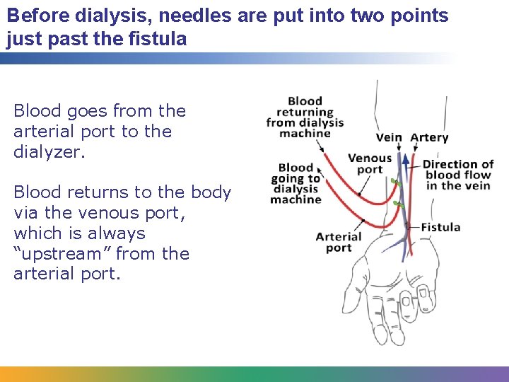 Before dialysis, needles are put into two points just past the fistula Blood goes