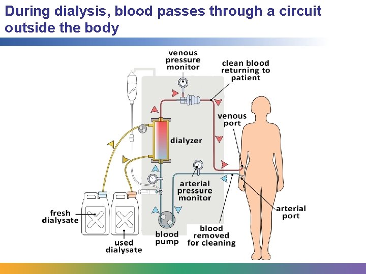 During dialysis, blood passes through a circuit outside the body 