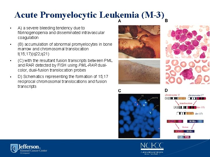 Acute Promyelocytic Leukemia (M-3) • A) a severe bleeding tendency due to fibrinogenopenia and