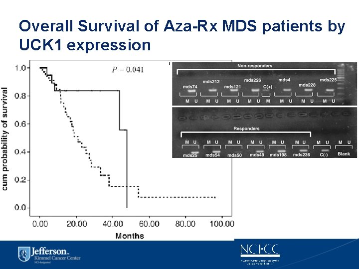 Overall Survival of Aza-Rx MDS patients by UCK 1 expression 