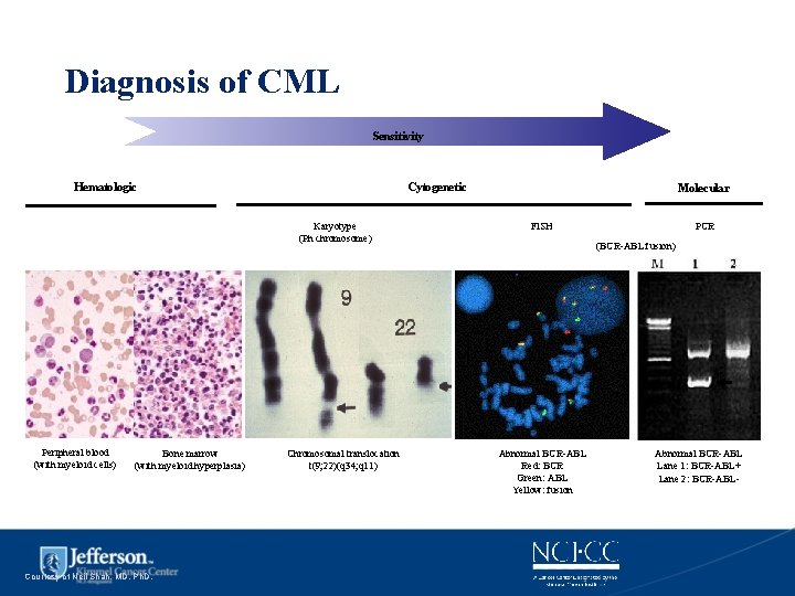 Diagnosis of CML Sensitivity Hematologic Cytogenetic Karyotype (Ph chromosome) Peripheral blood (with myeloid cells)