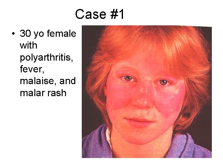 Case #1 • 30 yo female with polyarthritis, fever, malaise, and malar rash 
