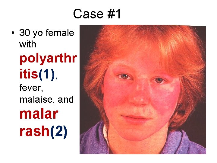 Case #1 • 30 yo female with polyarthr itis(1), fever, malaise, and malar rash(2)