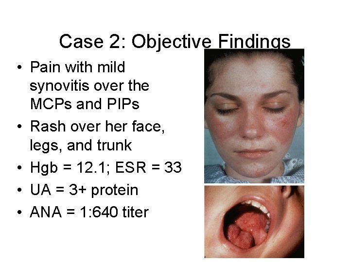 Case 2: Objective Findings • Pain with mild synovitis over the MCPs and PIPs