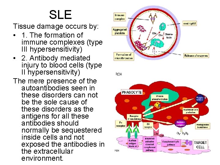 SLE Tissue damage occurs by: • 1. The formation of immune complexes (type III
