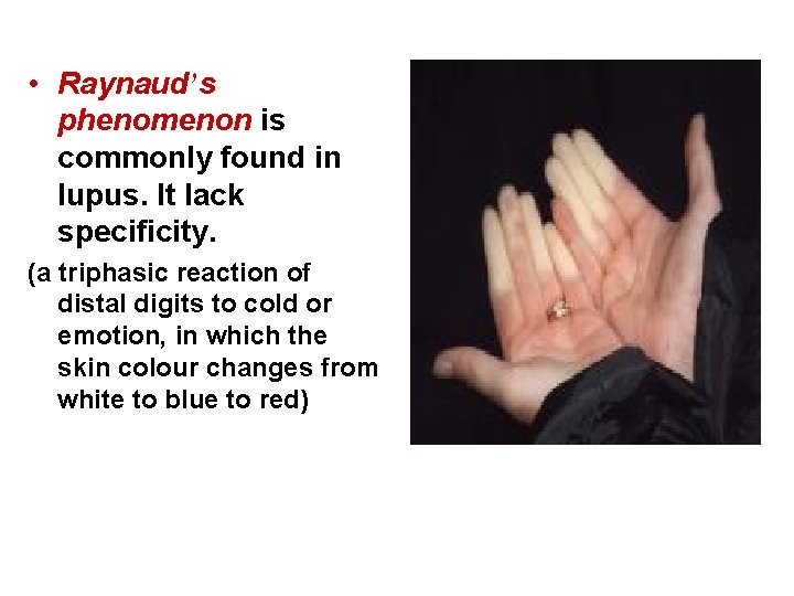  • Raynaud’s phenomenon is commonly found in lupus. It lack specificity. (a triphasic