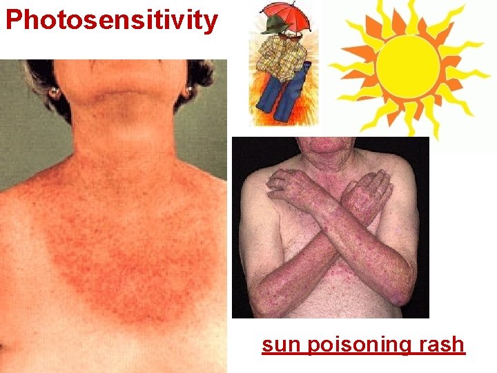 Photosensitivity sun poisoning rash 
