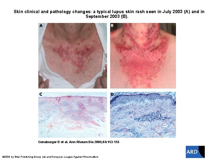 Skin clinical and pathology changes: a typical lupus skin rash seen in July 2003