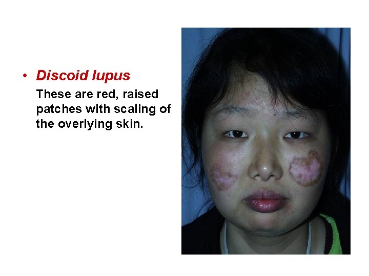  • Discoid lupus These are red, raised patches with scaling of the overlying