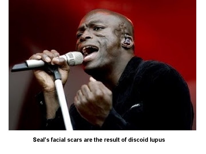 Seal’s facial scars are the result of discoid lupus 