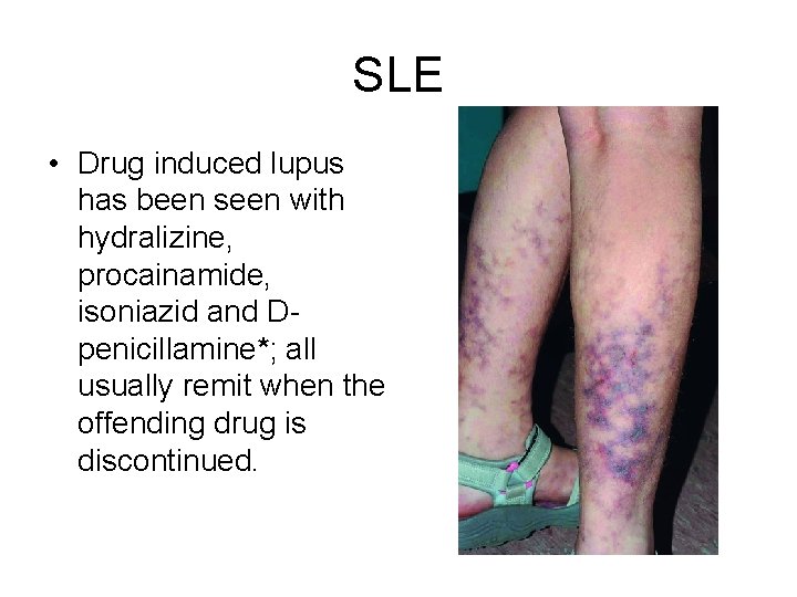 SLE • Drug induced lupus has been seen with hydralizine, procainamide, isoniazid and Dpenicillamine*;