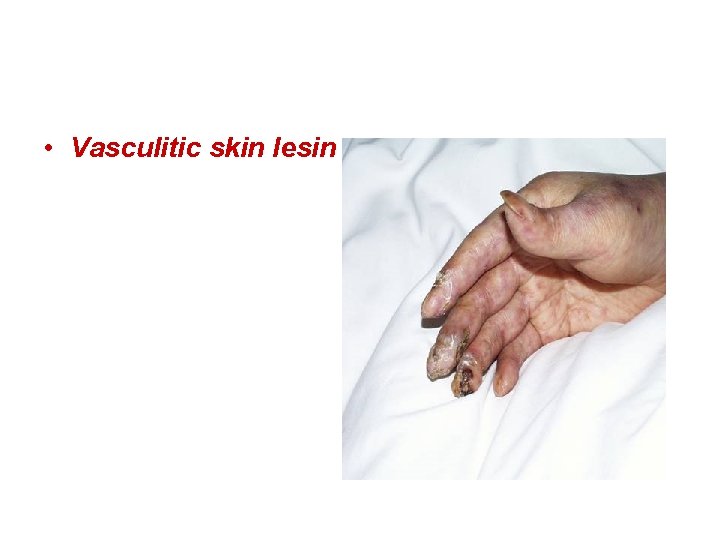  • Vasculitic skin lesin 