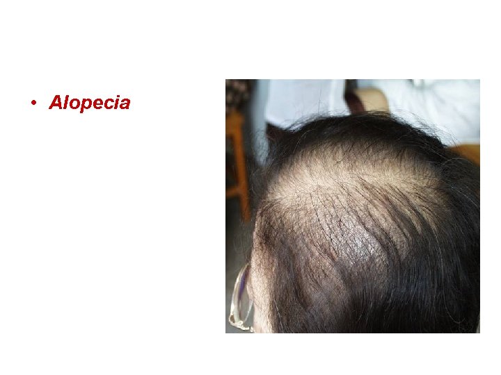  • Alopecia 