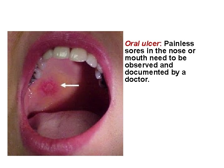  • Oral ulcer: Painless sores in the nose or mouth need to be
