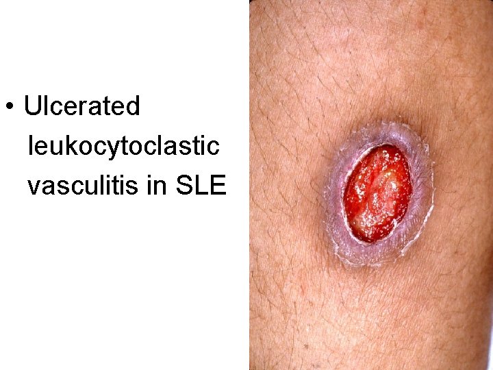  • Ulcerated leukocytoclastic vasculitis in SLE 