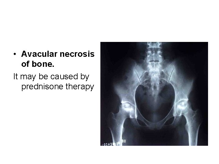  • Avacular necrosis of bone. It may be caused by prednisone therapy 