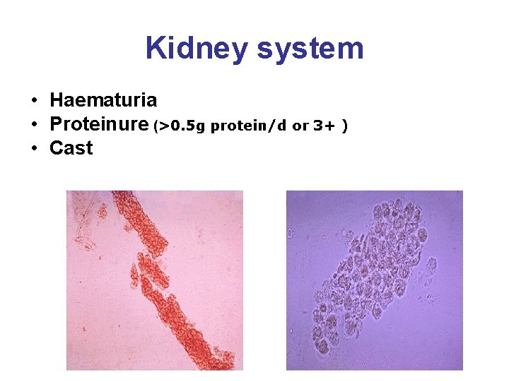 Kidney system • Haematuria • Proteinure (>0. 5 g protein/d or 3+ ) •