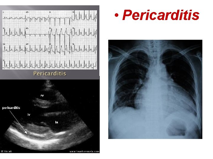  • Pericarditis 