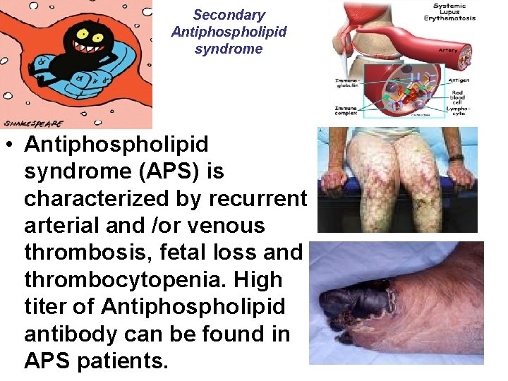 Secondary Antiphospholipid syndrome • Antiphospholipid syndrome (APS) is characterized by recurrent arterial and /or