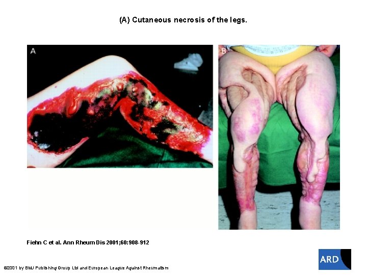 (A) Cutaneous necrosis of the legs. Fiehn C et al. Ann Rheum Dis 2001;