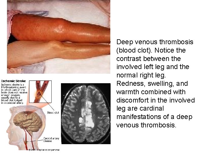  • Deep venous thrombosis (blood clot). Notice the contrast between the involved left