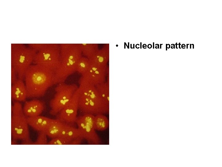  • Nucleolar pattern 