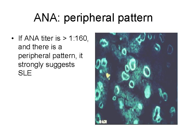 ANA: peripheral pattern • If ANA titer is > 1: 160, and there is