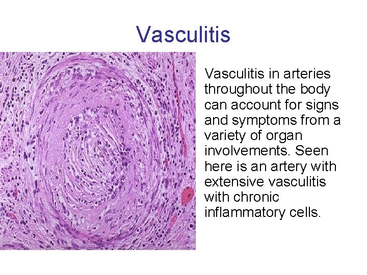 Vasculitis • Vasculitis in arteries throughout the body can account for signs and symptoms