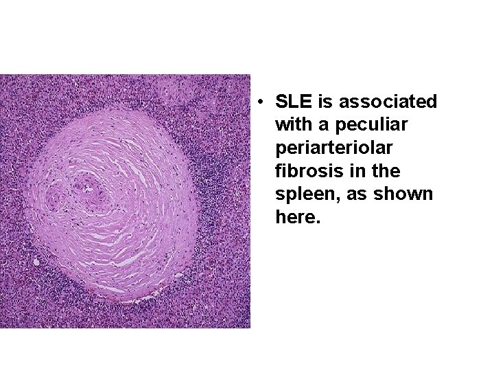  • SLE is associated with a peculiar periarteriolar fibrosis in the spleen, as