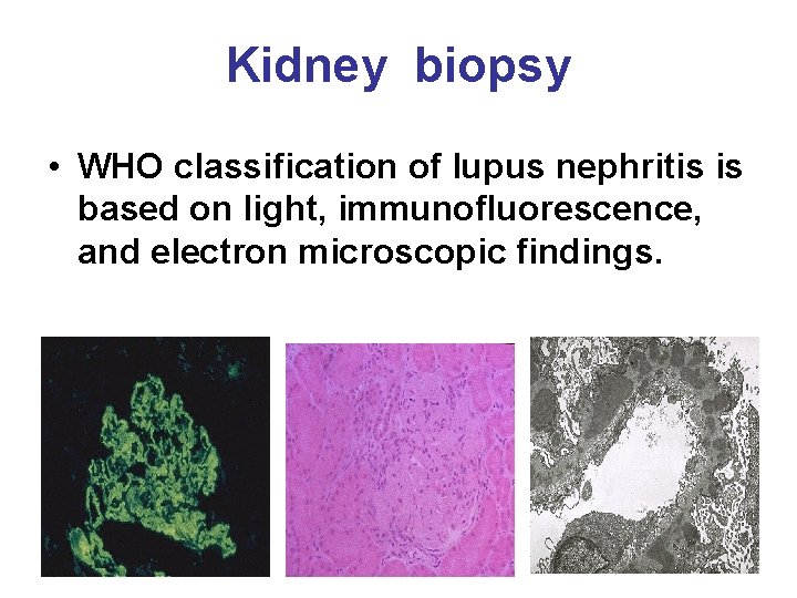 Kidney biopsy • WHO classification of lupus nephritis is based on light, immunofluorescence, and