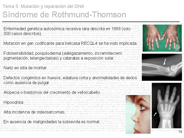 Tema 5. Mutación y reparación del DNA Síndrome de Rothmund-Thomson Enfermedad genética autosómica recesiva