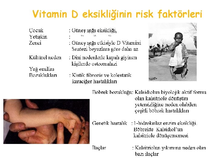 Vitamin D eksikliğinin risk faktörleri 