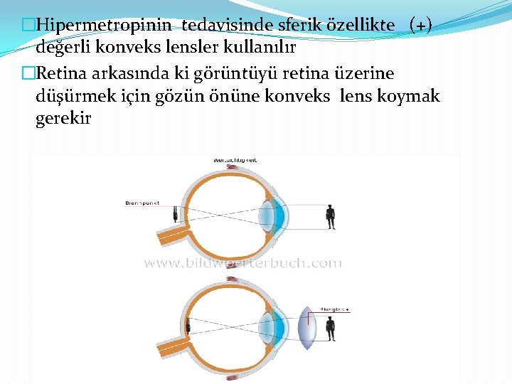 �Hipermetropinin tedavisinde sferik özellikte (+) değerli konveks lensler kullanılır �Retina arkasında ki görüntüyü retina