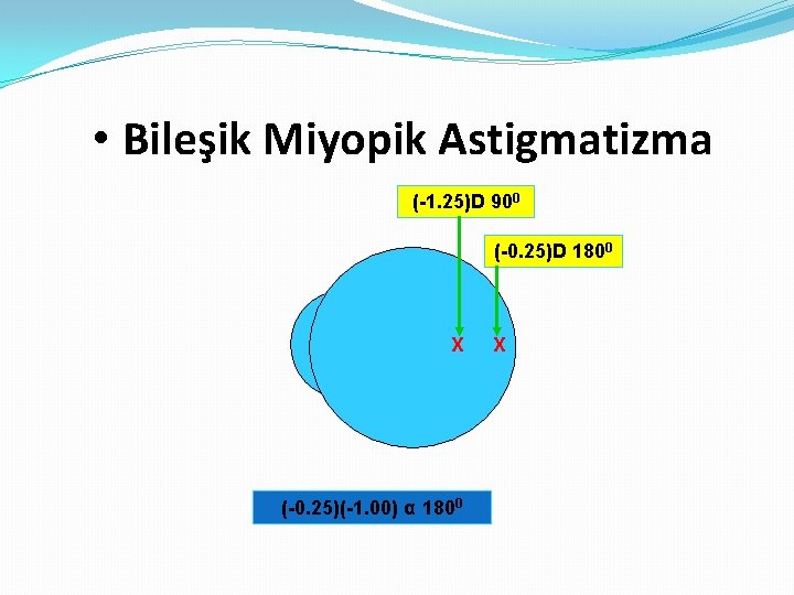  • Bileşik Miyopik Astigmatizma (-1. 25)D 900 (-0. 25)D 1800 X (-0. 25)(-1.