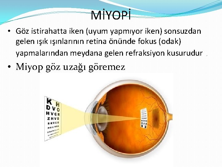 MİYOPİ • Göz istirahatta iken (uyum yapmıyor iken) sonsuzdan gelen ışık ışınlarının retina önünde